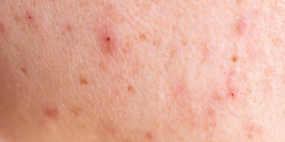 How can I reduce acne redness and swelling naturally?