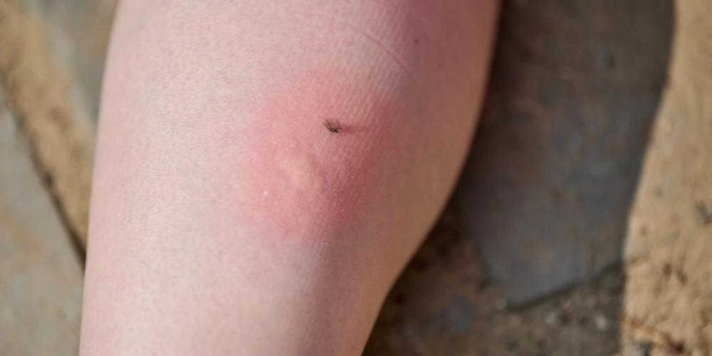 How can I reduce skin inflammation naturally?
