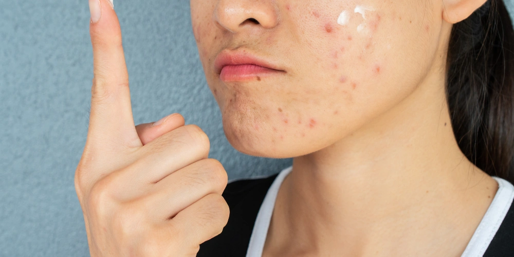 How can I prevent acne breakouts naturally at home?