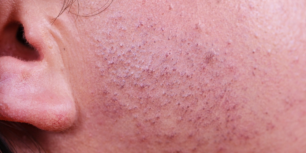 What are the natural ways to remove facial hair safely?