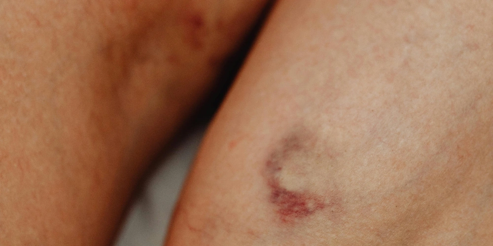 How can I naturally repair damaged skin at home?