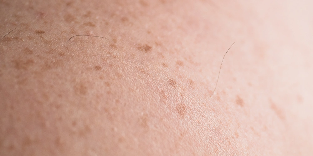 How can I improve my skin texture naturally?