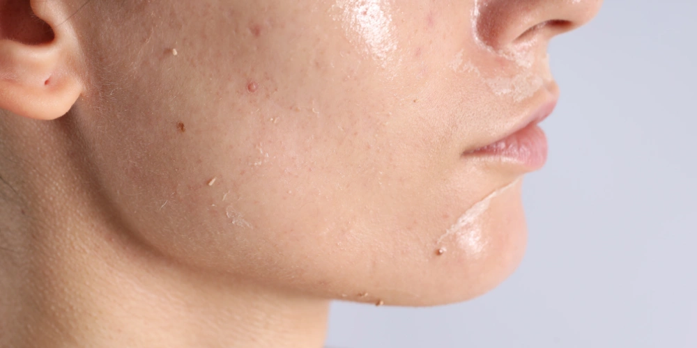 How can I maintain clear skin during summer season?